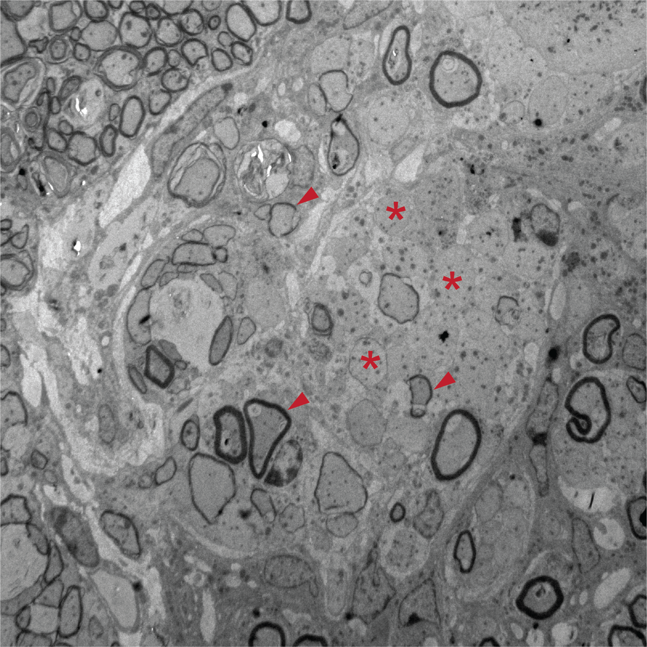 Close-up views of nerve fibres in mice with damaged spinal cords that received stem cell treatment, where nerve fibres appear covered and healthy, indicating repair. Close-up views of nerve fibres in mice with damaged spinal cords that received stem cell treatment, where nerve fibres appear covered and healthy, indicating repair.